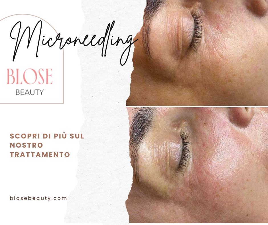 Scopri il microneedling a Milano con Blose Beauty